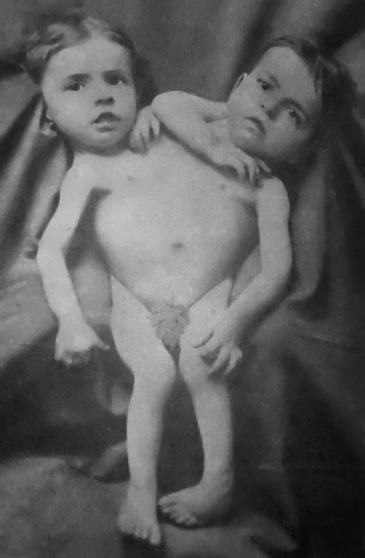 Les frères siamois